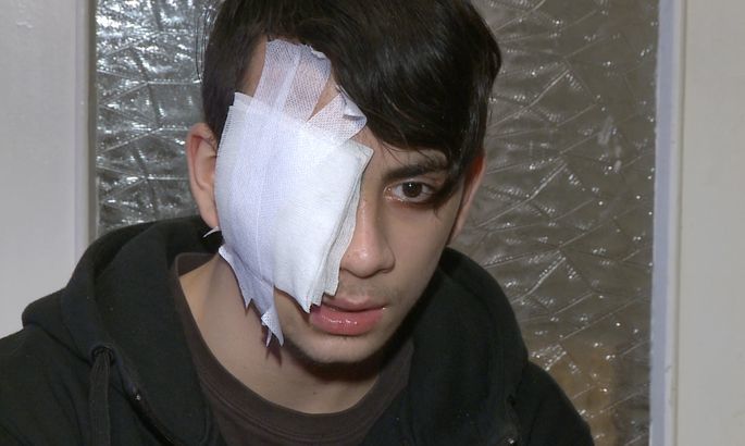 16-летний парень, получивший тяжелую травму глаза от выстрела резиновой пули в беспорядках 13 января