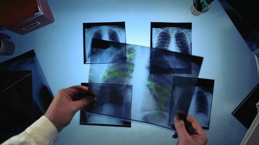 Латвия находится в первой пятерке европейских стран по уровню заболеваемости туберкулезом